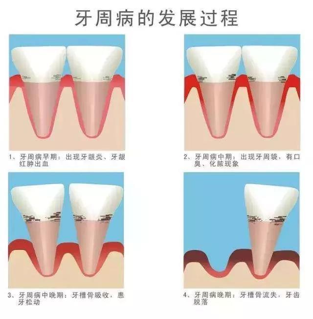 AVECMOI:牙周炎反复不见好 也许你需要益生菌来帮你